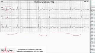 ECG Interpretation Tutorial  ChalkTalk 02  Basic Level [upl. by Ransome]