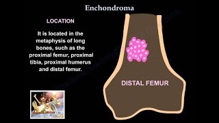 Chondroma of Soft Parts Extraskeletal Chondroma [upl. by Dorahs]