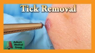 Dead Tick Removal  Auburn Medical Group [upl. by Kenward]