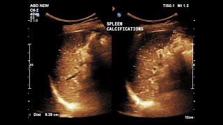 Splenic Calcifications  Ultrasound  Case 10 [upl. by Ilyssa]