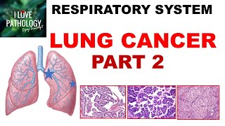 Malignant Bone Tumors  USMLE COMLEX NCLEX [upl. by Annij]