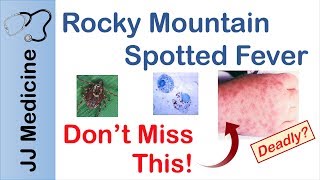 Rocky Mountain Spotted Fever  Bacteria Signs amp Symptoms Diagnosis and Treatment [upl. by Prinz]