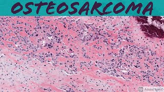 LUNG CANCER  Part 2 Morphology Clinical features [upl. by Alviani]