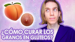 GRANOS en GLUTEOS Causas tratamientos productos para comprar [upl. by Oehsen]