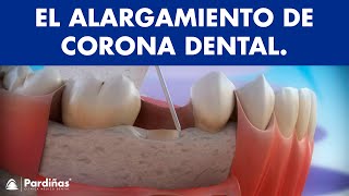 Alargamiento de corona dental © [upl. by Airotkiv]