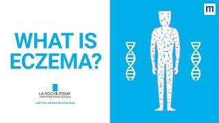 What Is Eczema  La RochePosay [upl. by Marleah948]