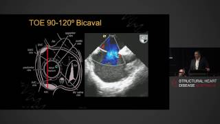 Esophageal Atresia  What is Esophageal Atresia [upl. by Ylsel]