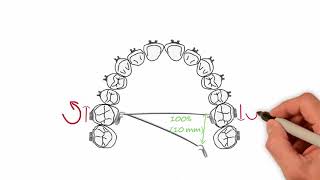 Transpalatal Arch Activations  Essential Biomechanics [upl. by Campbell]