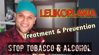 LeukoplakiaTreatment amp Prevention  मुंह में सफेद दाग के लक्षण कारण इलाज  Oral Hairy Leukoplakia [upl. by Fran]