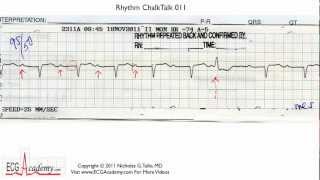 ECG Interpretation Tutorial  ChalkTalk 11  Basic Level [upl. by Lanoil]