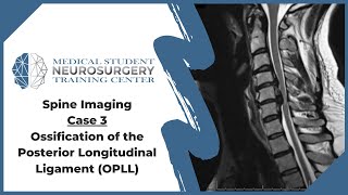 Spine Imaging Case 3 Ossification of the Posterior Longitudinal Ligament OPLL [upl. by Rodoeht564]