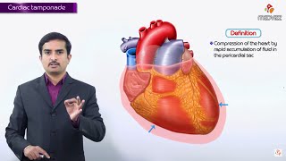 Cardiac Tamponade  causes ECG Diagnosis Pathology Clinical findings Treatment [upl. by Allehcim]