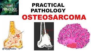 OSTEOSARCOMA Clinical  Radiological features amp Morphology [upl. by Anitan]