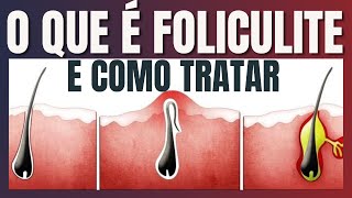 O que é Foliculite e como tratar [upl. by Ailbert]