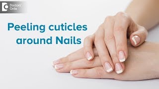 What to do for peeling cuticles around nails  Dr Rasya Dixit  Doctors Circle [upl. by Ennasil]