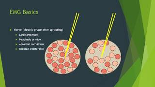 Polymyalgia Rheumatica  Signs amp Symptoms Diagnosis and Treatment [upl. by Llednor729]