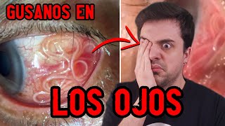 Gusanos en los ojos  LOIASIS [upl. by Hcurob]