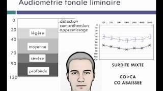 Hearing Loss Simulation  Whats It Like [upl. by Okemak496]