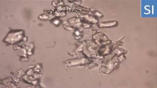 Uric acid crystals urine [upl. by Rosecan]