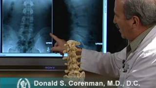 How to Read Xrays of the Lumbar Spine Lower Back  Spine Surgeon Colorado [upl. by Aihceyt]