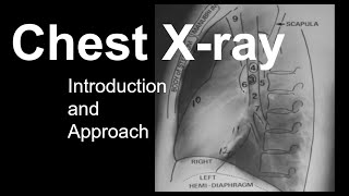 Chest Xray Introduction and Approach [upl. by Azila]