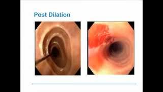 Eosinophilic Esophagitis [upl. by Adalard674]