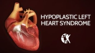 Mayo ClinicHypoplastic Left Heart Syndrome [upl. by Downes893]