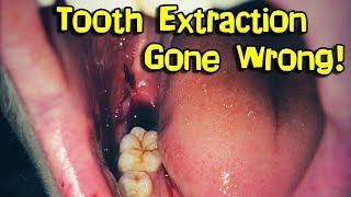 Wisdom Teeth Removal Extraction [upl. by Arman211]