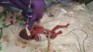 World’s smallest surviving baby born in San Diego [upl. by Aenitsirhc]