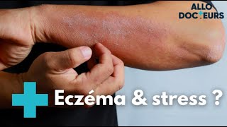 Eczéma  quelles solutions   Allo Docteurs [upl. by Rodge]