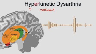 Hyperkinetic Dysarthria  samples and explanation [upl. by Mort]