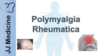 Polymyalgia Rheumatica  Signs amp Symptoms Diagnosis and Treatment [upl. by Norra442]