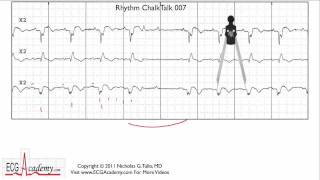 ECG Interpretation Tutorial  ChalkTalk 07  Advanced Level [upl. by Lamberto]