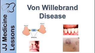 Von Willebrand Disease  Pathophysiology Types Symptoms and Treatment [upl. by Yendor]