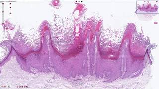 Verruca Vulgaris  Histopathology [upl. by Lance964]