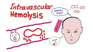 Intravascular Hemolysis [upl. by Beekman562]