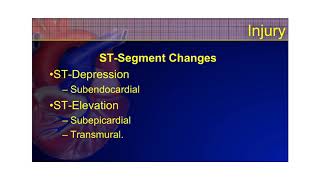 The 12Lead ECG Course  STEMI Part 2 [upl. by Yrahcaz706]