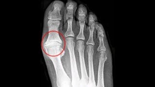 Big Toe Joint Pain Causes Home Treatment Guide [upl. by Netsrak308]