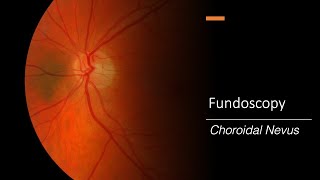 Choroidal Nevus Fundoscopy [upl. by Yeliak]