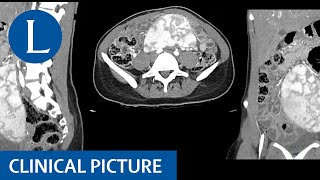 A wandering spleen splenomegaly hypersplenism and iron deficiency anaemia [upl. by Zampardi]