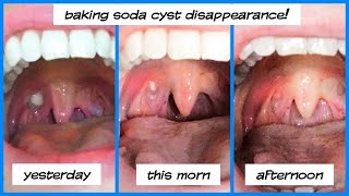 Tonsil Bed  How to remember [upl. by Sire485]