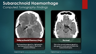 Subarachnoid Hemorrhage SAH Computed Tomography Scan Findings [upl. by Cung]