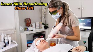 Laser Skin Resurfacing  by Clear Lift  Harmony XL Pro  best full demo  treatment fully explained [upl. by Stefanie462]