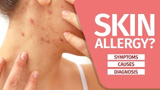 What is Skin Allergy Symptoms Causes Diagnosis and Triggers [upl. by Ennovart67]