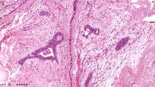 Fibroadenoma  Histopathology [upl. by Nyloc]