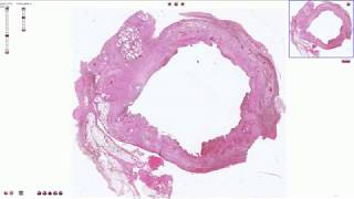 Chronic Cholecystitis  Histopathology [upl. by Aken]