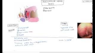 Peritonsillar Abscess Quinsy for USMLE Step 2 [upl. by Ordnasela]