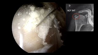 EPAULE N°3  Calcification [upl. by Hopkins]