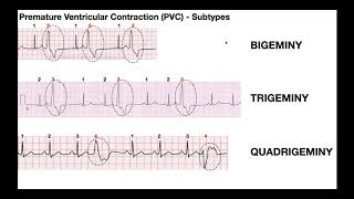 EKG Patterns  Premature Atrial amp Ventricular Contractions PACs amp PVCs [upl. by Appolonia]