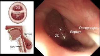 PHARYNGEAL POUCH DIFFICULT INTUBATION [upl. by Sall]